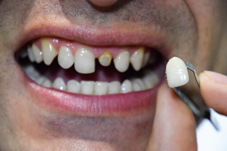 Dentals Crowns